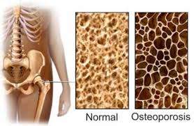 Osteoporosis: Verdades y Falsedades